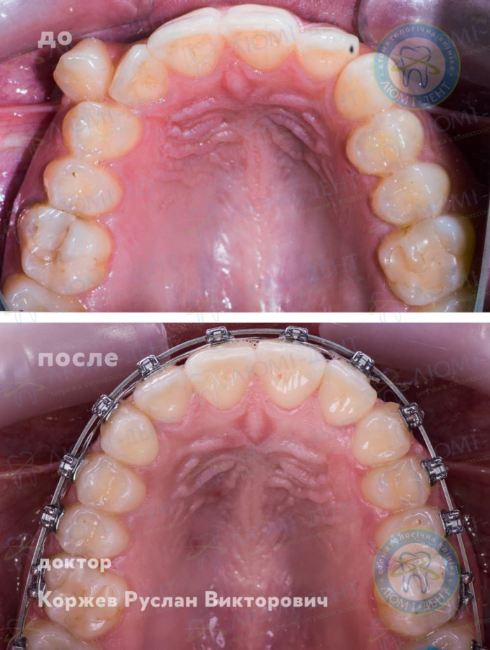 Как работают брекеты фото Люми-Дент