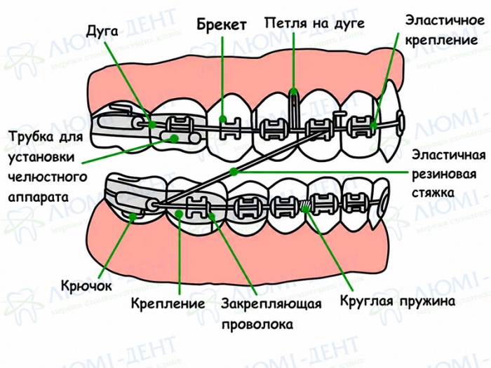 Как ставят брекеты фото Люми-Дент