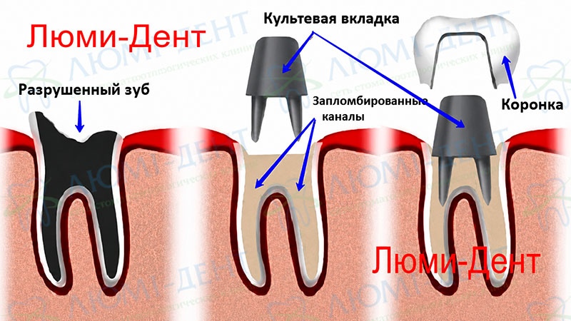 Коронки на зубы фото Люми-Дент