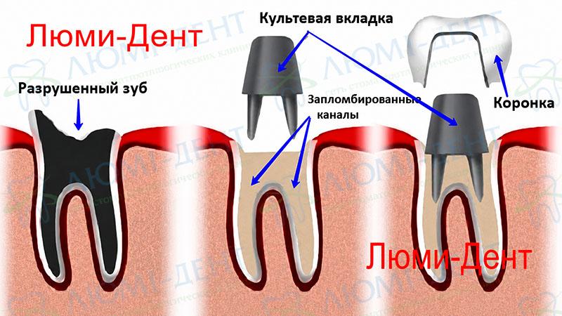 Схема изготовления коронки на штифте Коронки на зубы фото Люми-Дент