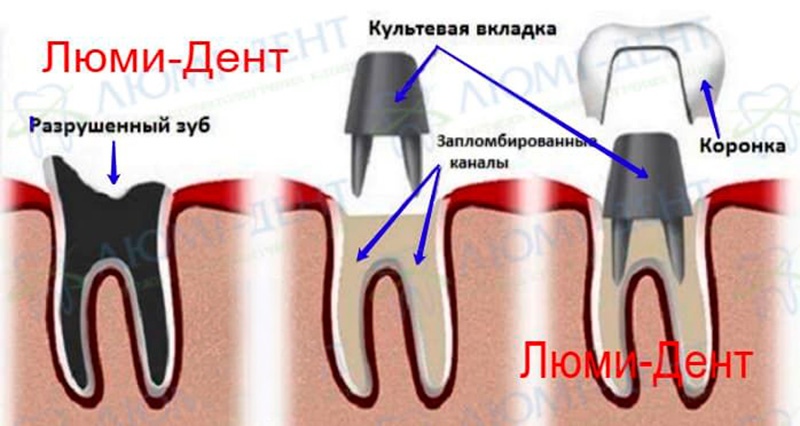 Схема изготовления коронки на штифте Коронки на зубы фото Люми-Дент