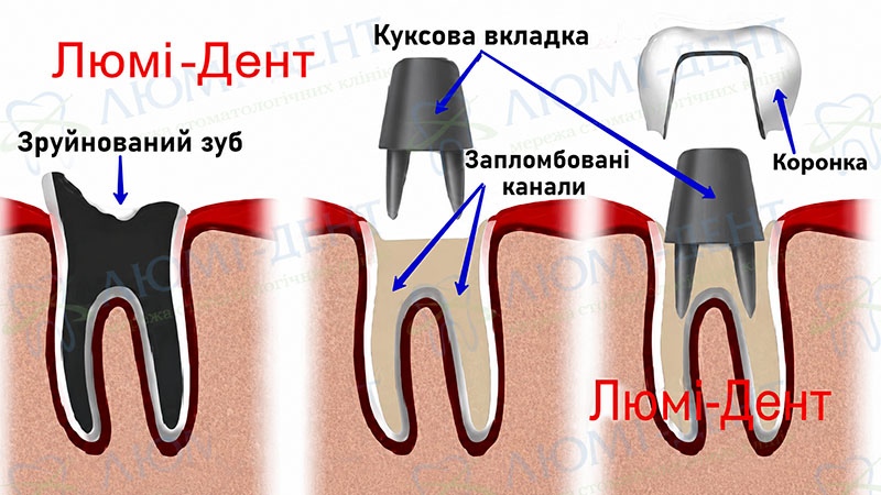 Схема виготовлення коронки на штифті Коронки на зуби фото Люмі-Дент