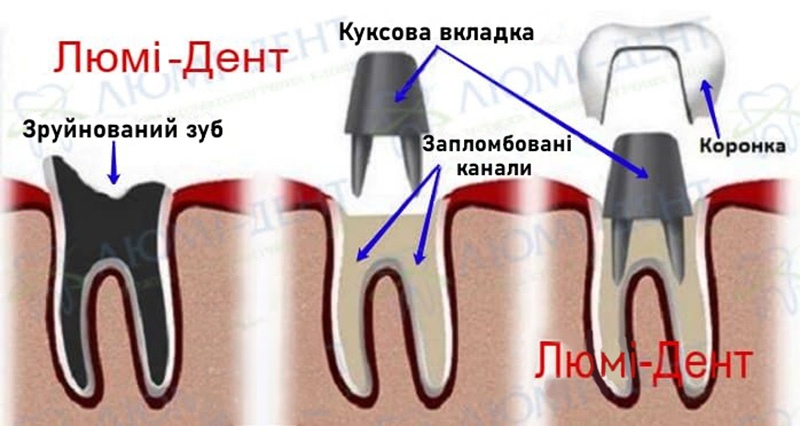 Схема виготовлення коронки на штифті Коронки на зуби фото Люмі-Дент
