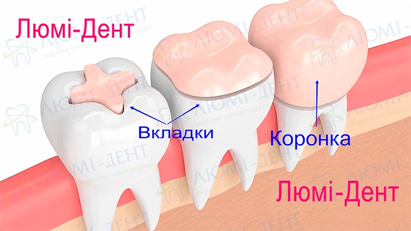 Різниця між вкладками та коронками Зубні коронки фото Люмі-Дент