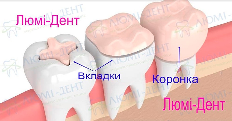 Різниця між вкладками та коронками Зубні коронки фото Люмі-Дент