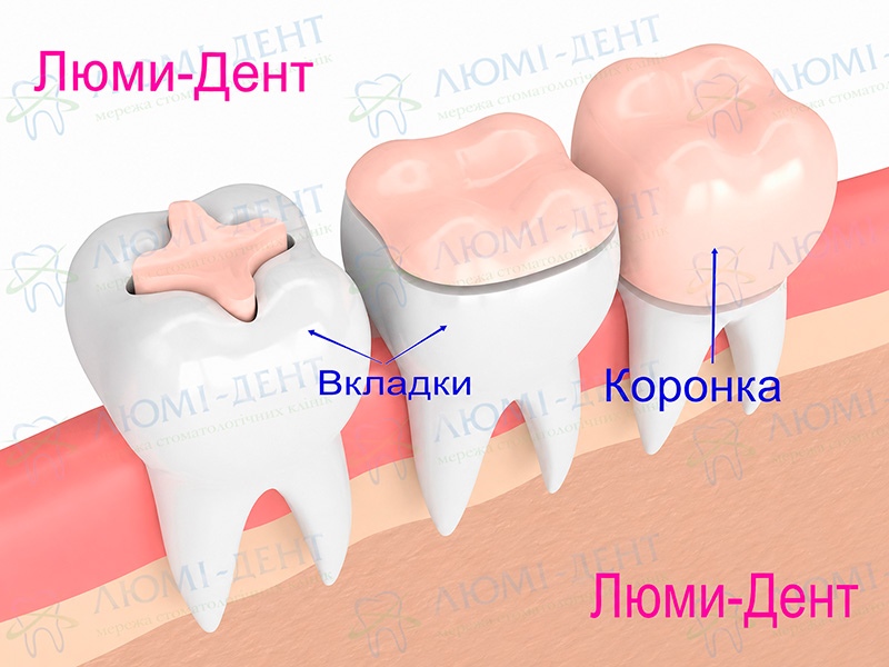 Зубные коронки фото Люми-Дент