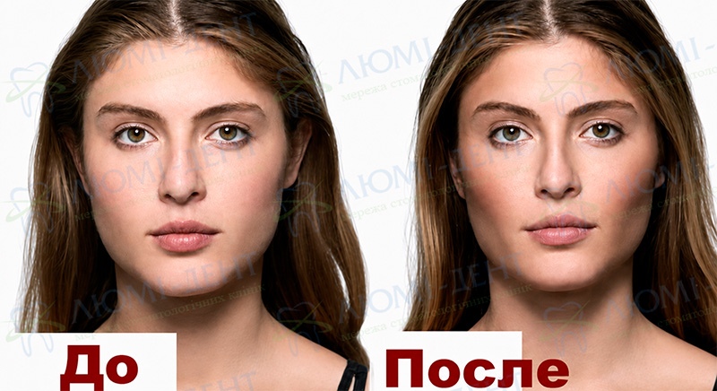 Фото до и после удаления комков Биша Фото до и после удаления комков Биша