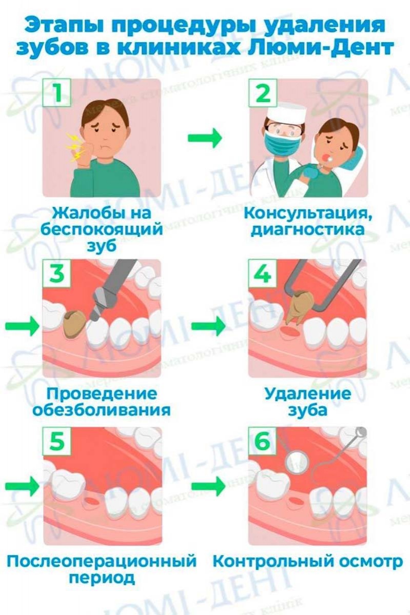Этапы удаления зубов в клинике Этапы удаления зубов в клинике