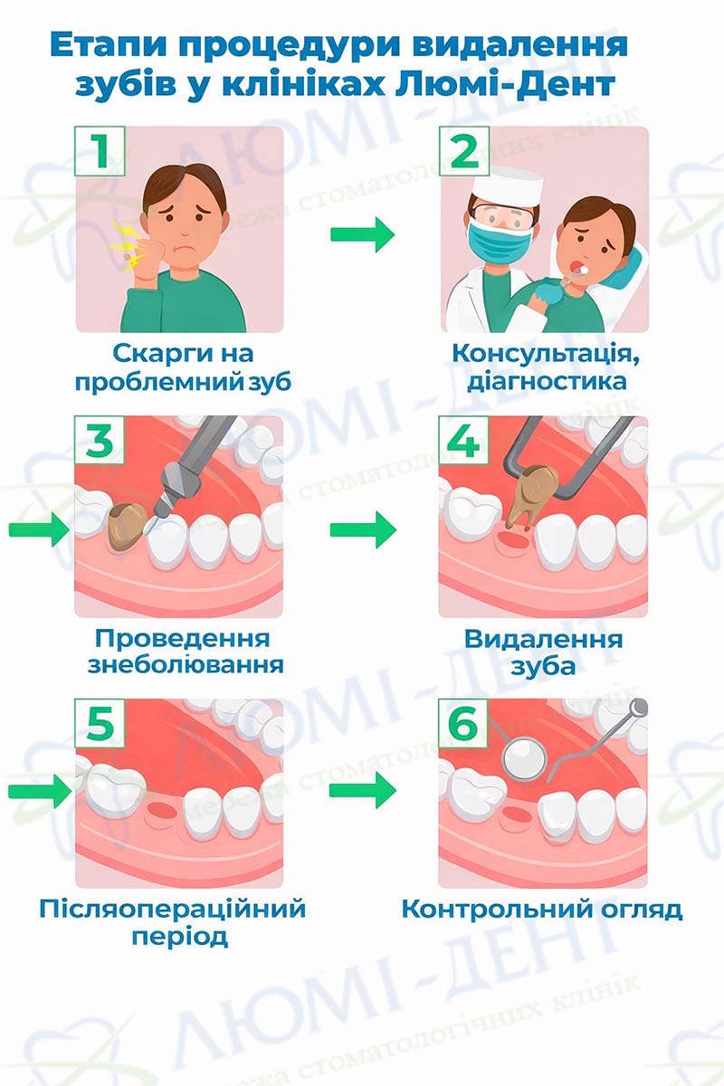 Етапи видалення зубів у клініці Етапи видалення зубів у клініці