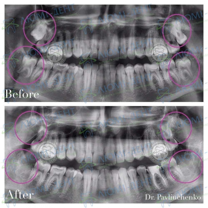 як видаляють зуб мудрості фото Люмі-Дент