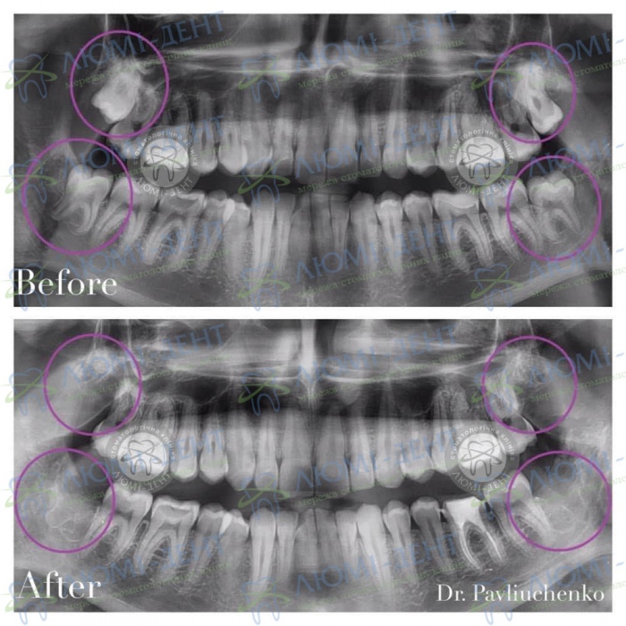 зуб мудрости как удаляют фото Люми-Дент