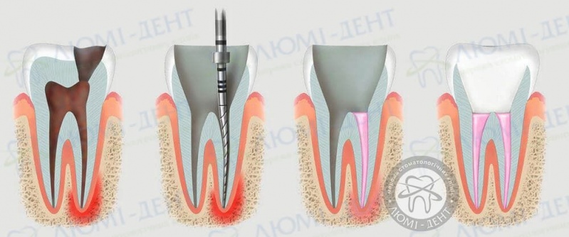 Больно ли удалять нерв фото Люми-Дент