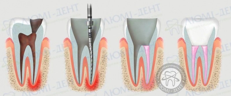 чому болить зуб після видалення нерва фото Люмі-Дент