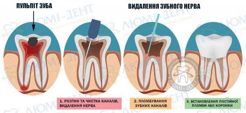 видалення нерва зуба наслідки фото Люмі-Дент