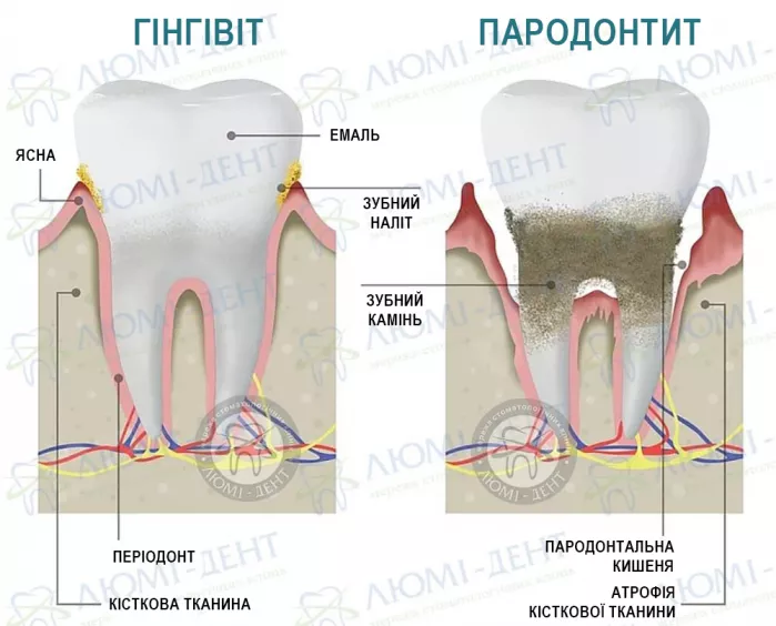 Захворювання ясен Зміцнення ясен фото ЛюміДент