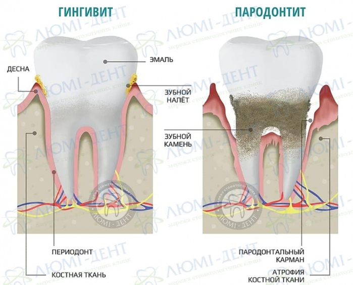 Укрепление десен фото ЛюмиДент