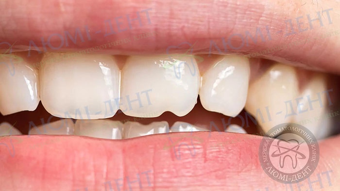 почему крошатся зубы фото Люми-Дент