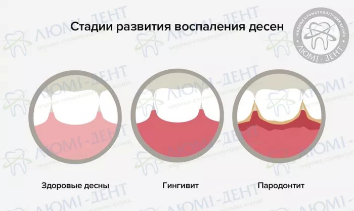 Стадии развития воспаления десен Отек десны фото Люми-Дент