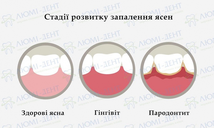 Як зняти набряк ясен фото Люмі-Дент