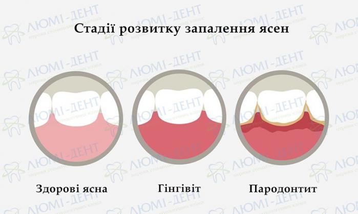 Стадії розвитку запалення ясен Як зняти набряк ясен фото Люмі-Дент