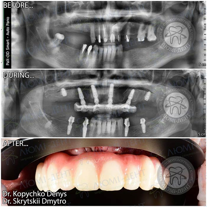 Дешевые импланты зубов фото ЛюмиДент