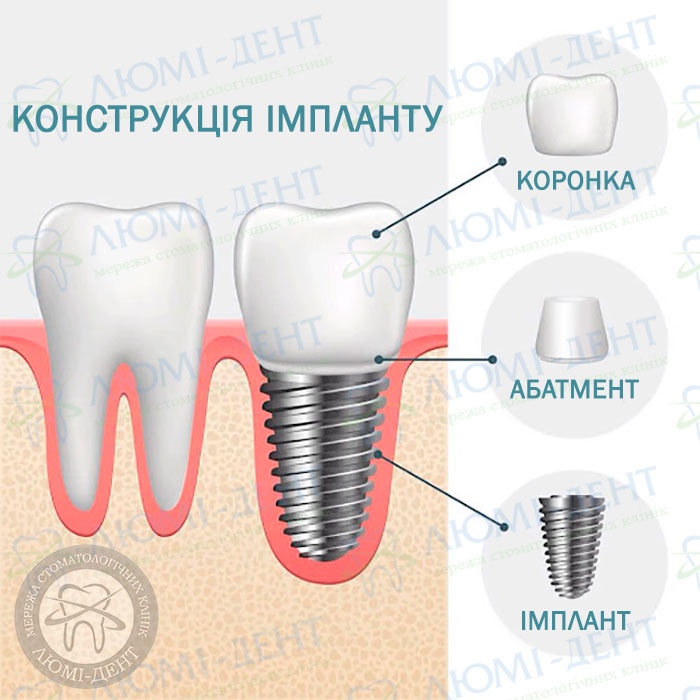 найдешевші імпланти фото Люмі-Дент