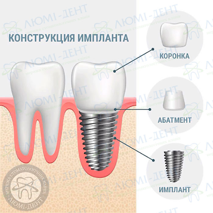 Зубные импланты недорого фото ЛюмиДент
