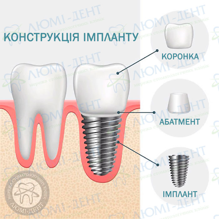 Зубні імпланти недорого фото ЛюміДент