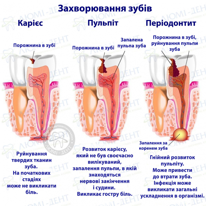 болить зуб при накушуванні фото ЛюміДент