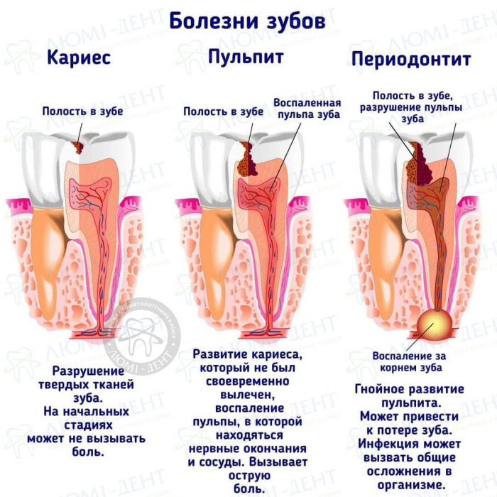 болит зуб при накусывании фото ЛюмиДент