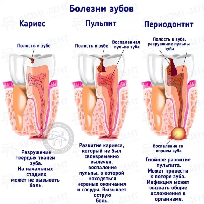 https://www.lumident.kiev.ua/images/files/filemanager/FAQ/Pochemu-bolit-zub-pri-nakusyvanii/bolit-zub-pri-nakusyvanii_1495945292.webp