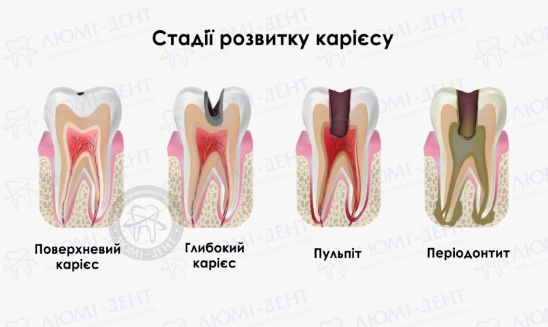 болить зуб при натисканні на нього фото ЛюміДент