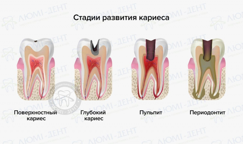 болит зуб при нажатии на него фото ЛюмиДент