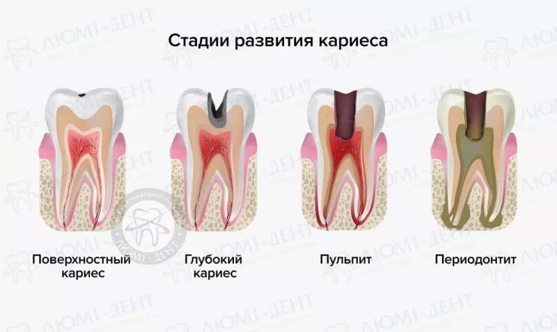 Стадии развития кариеса болит зуб при нажатии на него фото ЛюмиДент