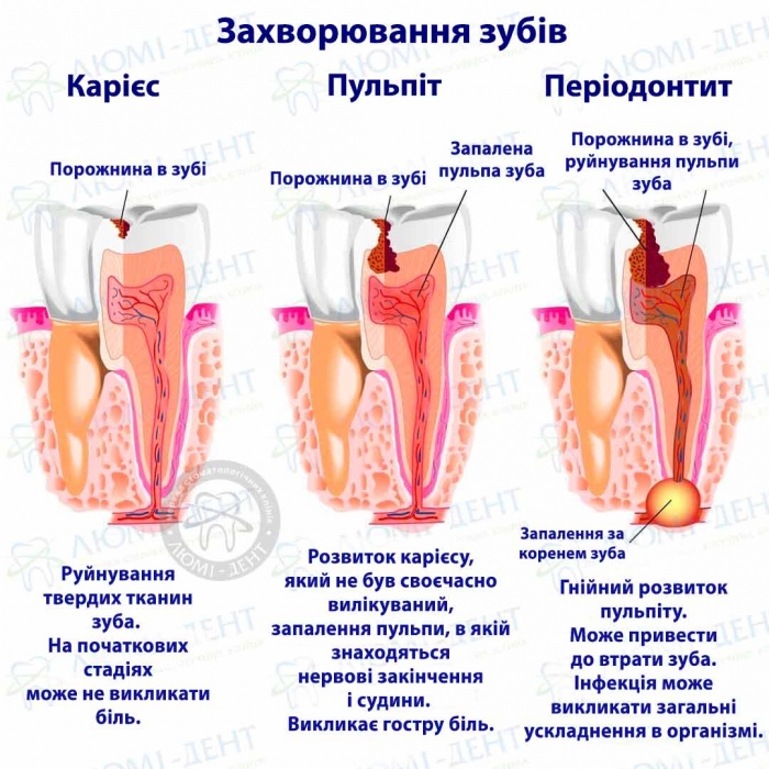 болить зуб при натисканні фото Люмі-Дент