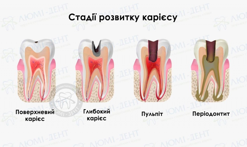 чому болить зуб при натисканні фото Люмі-Дент