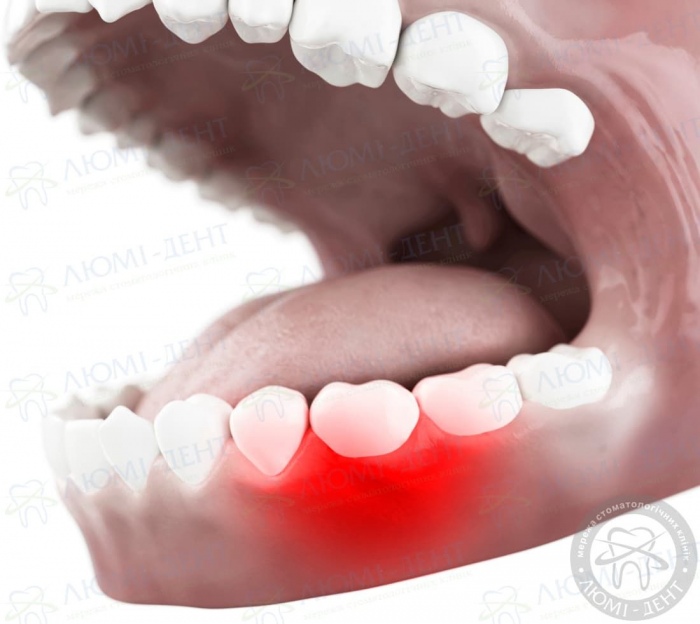 скільки часу болить зуб після пломбування фото Люмі-Дент