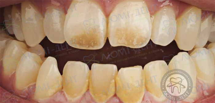 Пигментация зубов фото ЛюмиДент