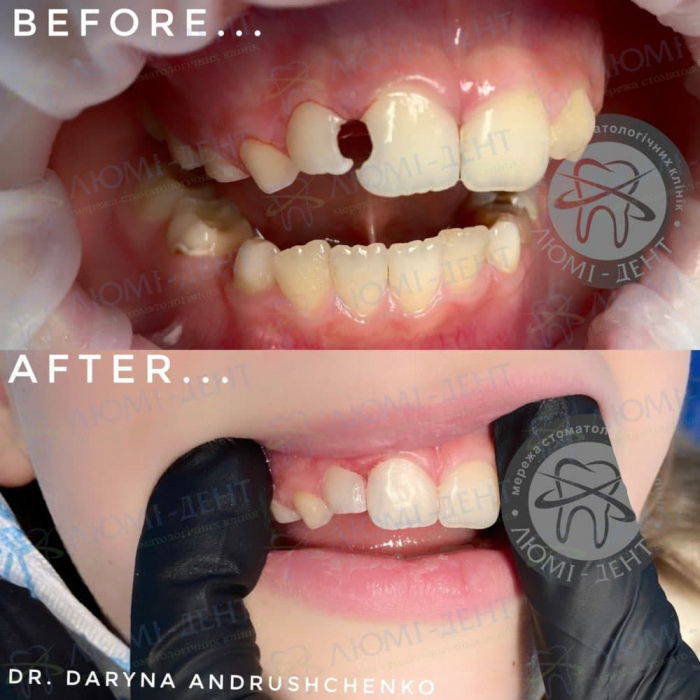 лечение и реставрация молочных зубов фото ЛюмиДент