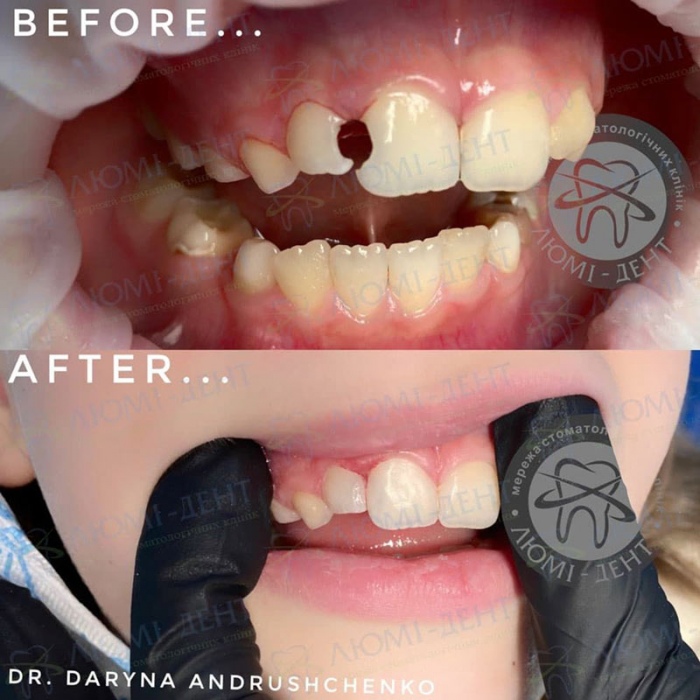 Лікування і реставрація молочних зубів фото Люмі-Дент