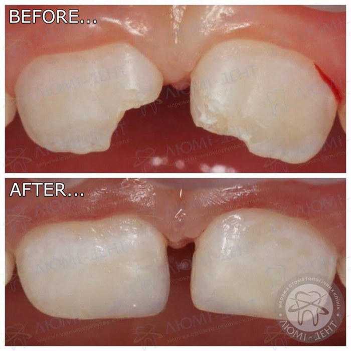 Реставрація молочних зубів фото Люмі-Дент