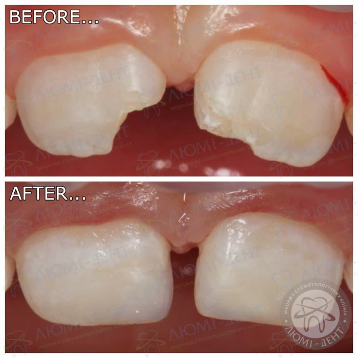 реставрация молочных зубов фото ЛюмиДент