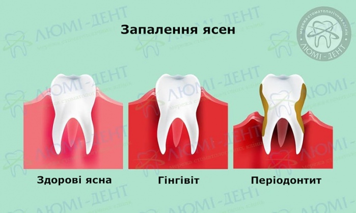 Запалилися ясна що робити фото Люмі-Дент