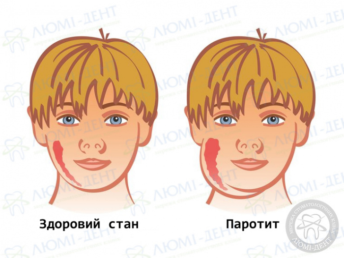 лімфовузол під щелепою фото ЛюміДент