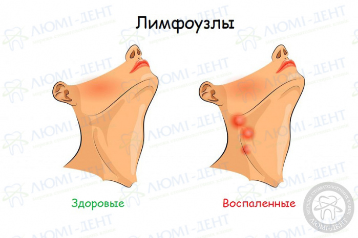 Воспалился лимфоузел под челюстью фото Люми-Дент