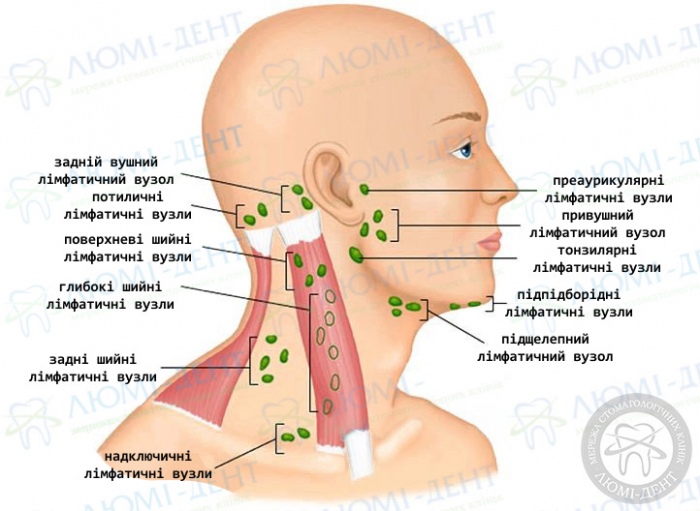 Збільшений підщелепний лімфовузол фото Люмі-Дент