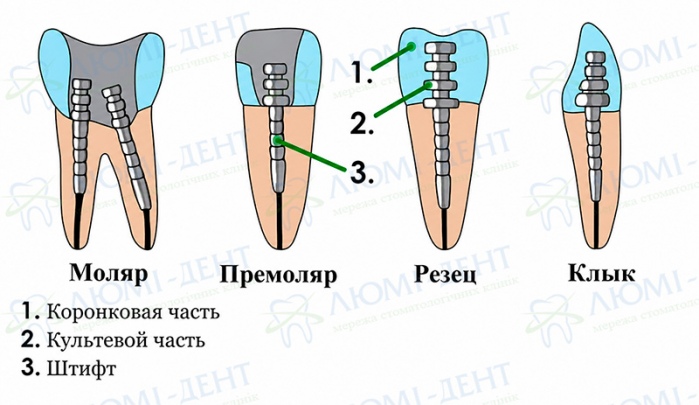 Зубной штифт последствия фото Люми-Дент