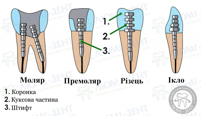 зубний штифт наслідки фото ЛюміДент