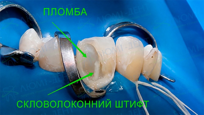Скловолоконний штифт фото Люмі-Дент