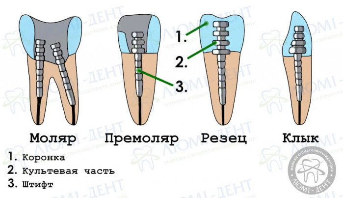 зубной штифт последствия фото ЛюмиДент